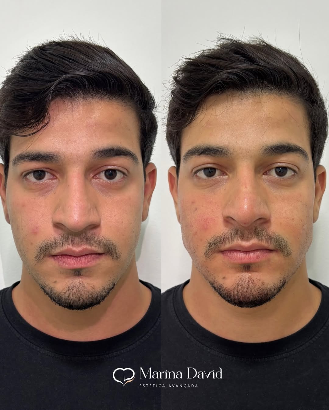 Harmonização FULLFACE trazendo mais contorno e ângulo na mandíbula, proporcionando mais confianç