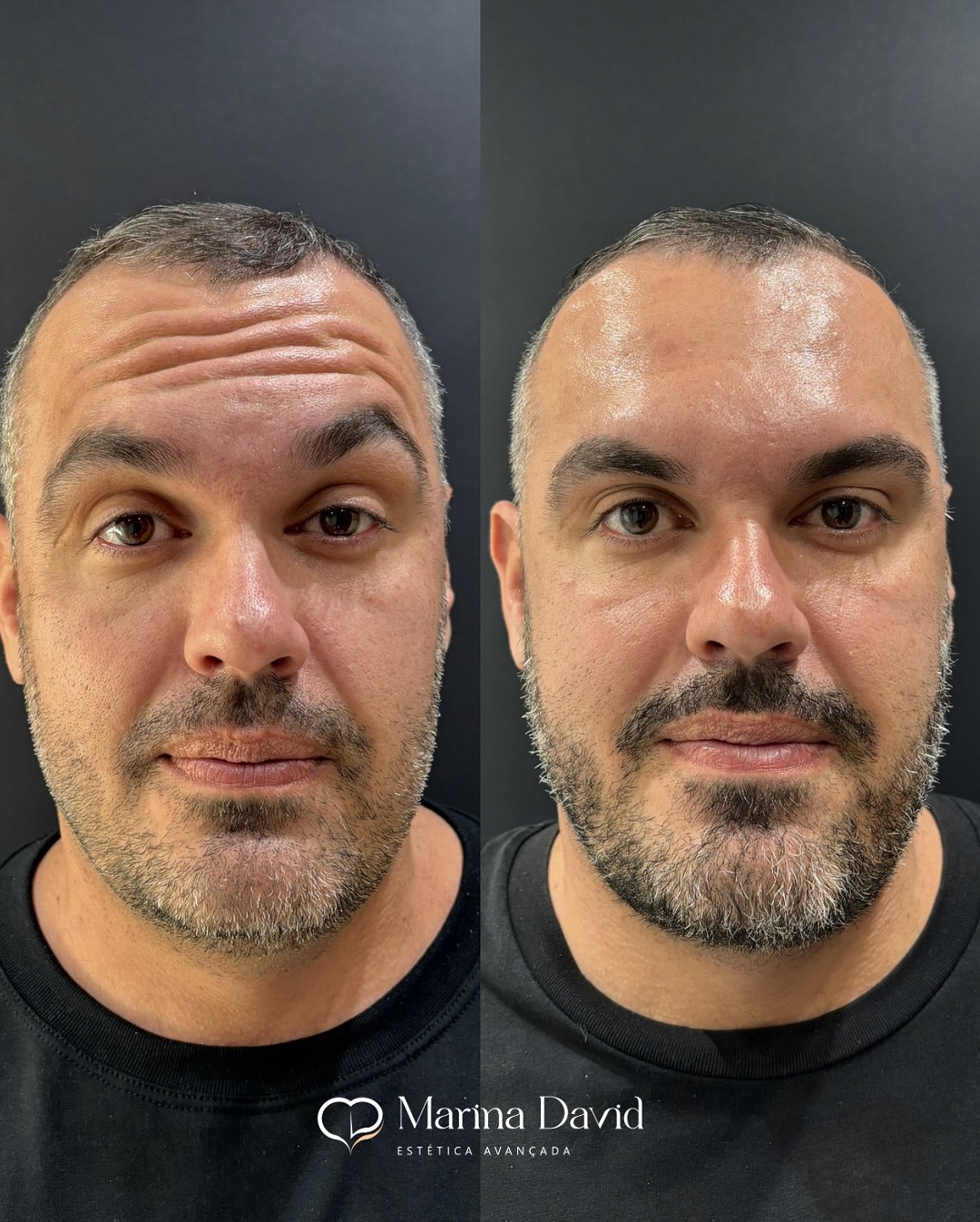 Homem também se cuida — e com resultado! 💉🧔🏻_♂️Nesse antes e depois, conseguimos suavizar as