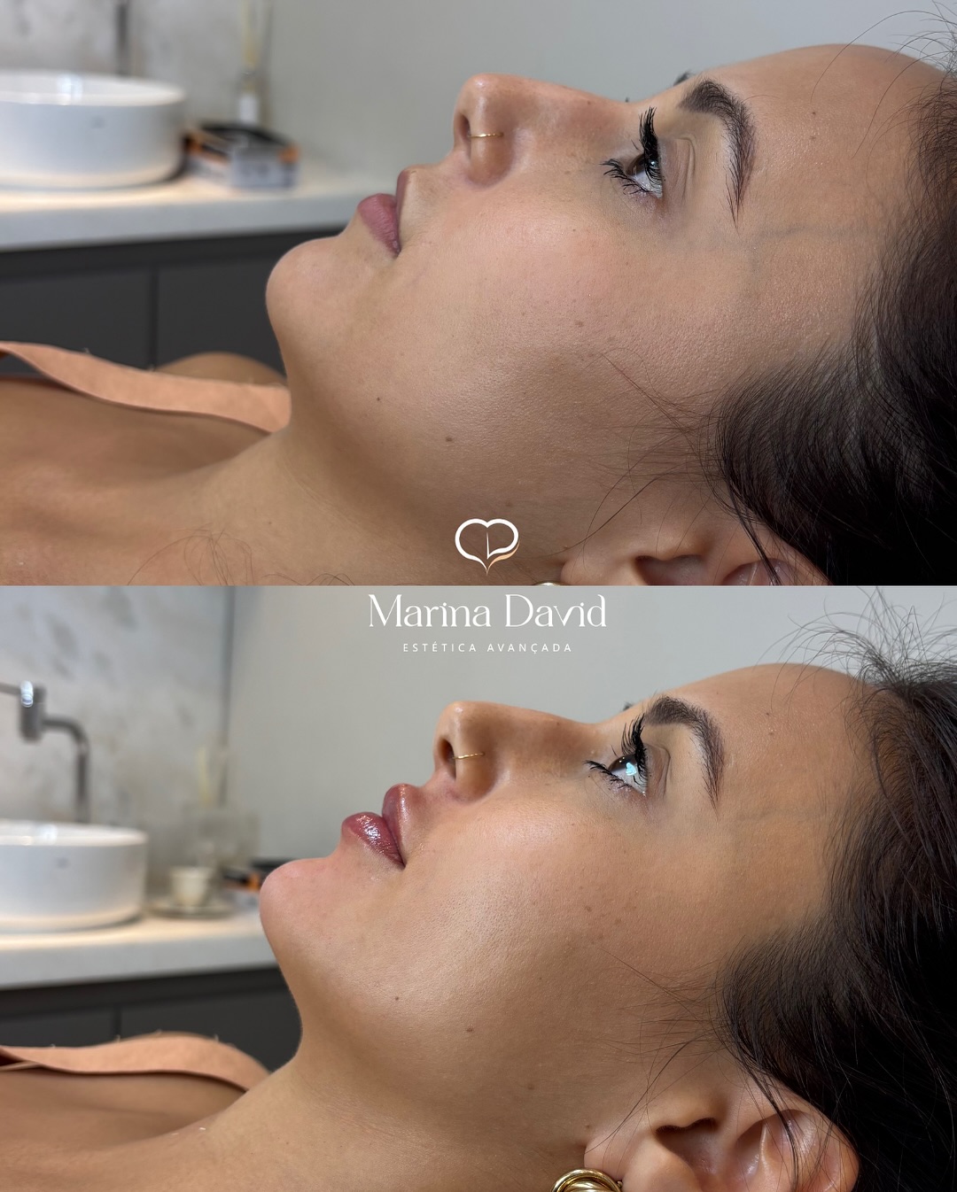 Pefiloplastia não cirúrgica ✨🤌🏼Preenchimento labial e mentual para alinhamento de perfil, melh