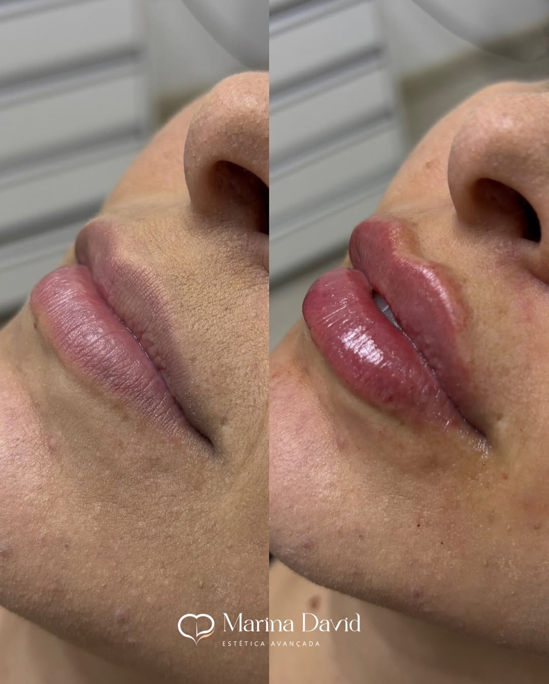 Preenchimento Labial 👄#preechimentolabial #labiosperfeitos #labios💋 #labio #