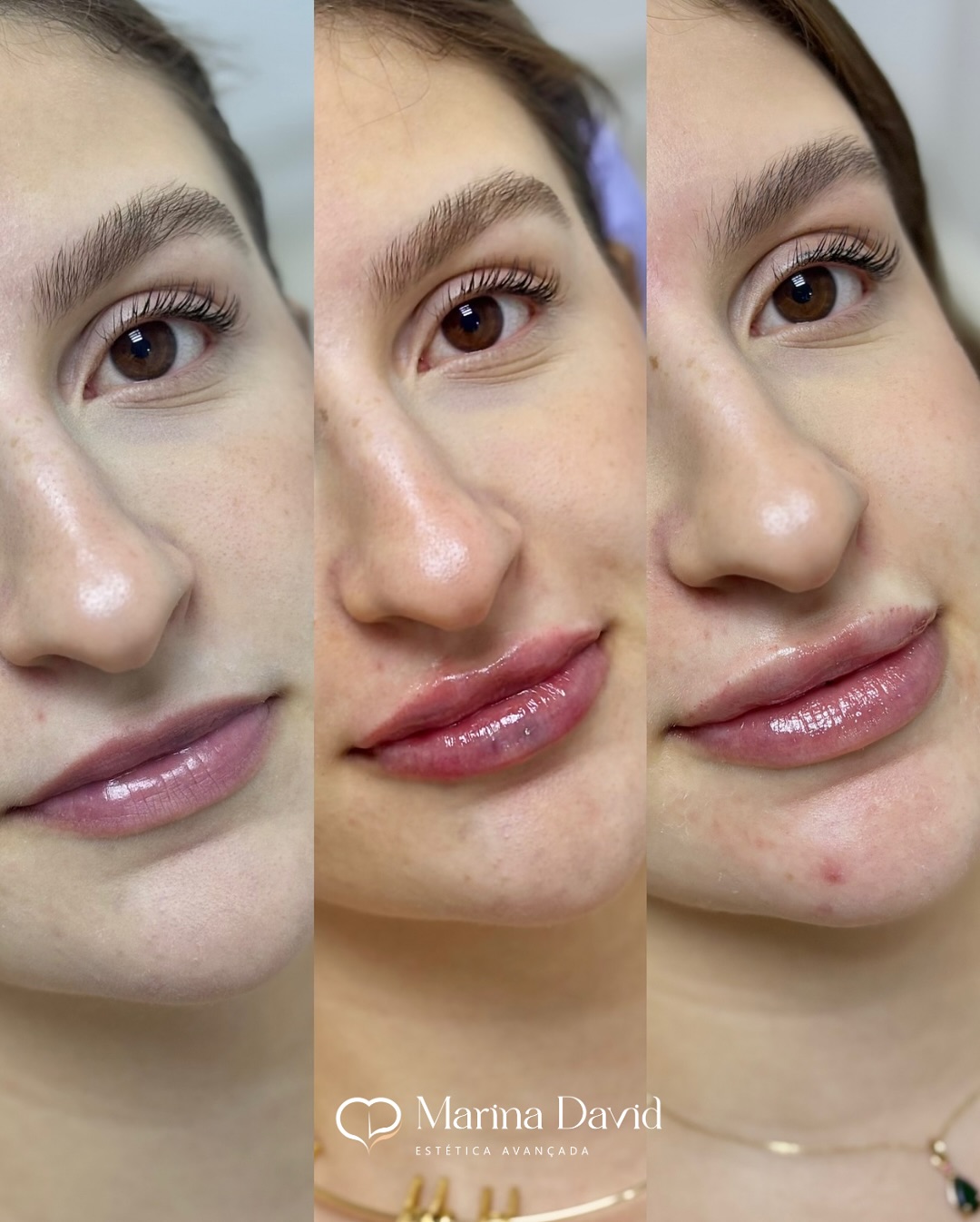 Resultado de preenchimento labial + botox 👄💉 Ela realizou preenchimento labial com outra profi