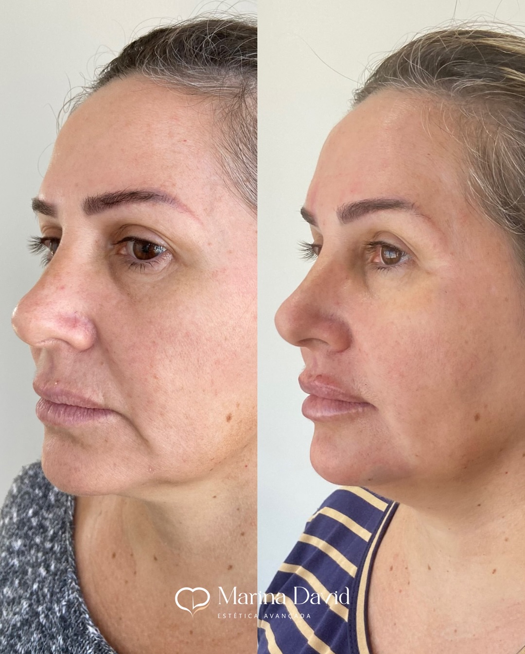 ✨ Transformação completa com técnica e harmonia!Nesta paciente, realizamos-✔ Fios de tração para